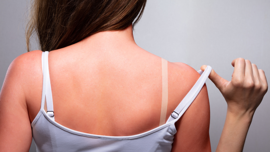 Woman who is burned through the sun